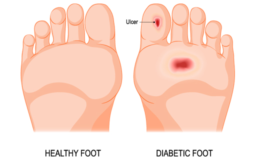 piede sano e piede diabetico